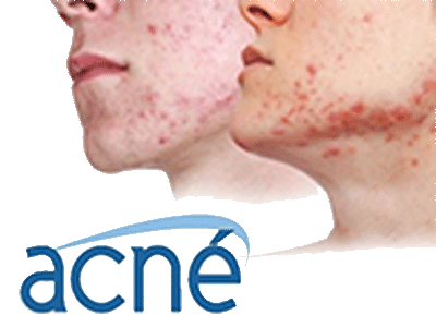 estudios-de-acne